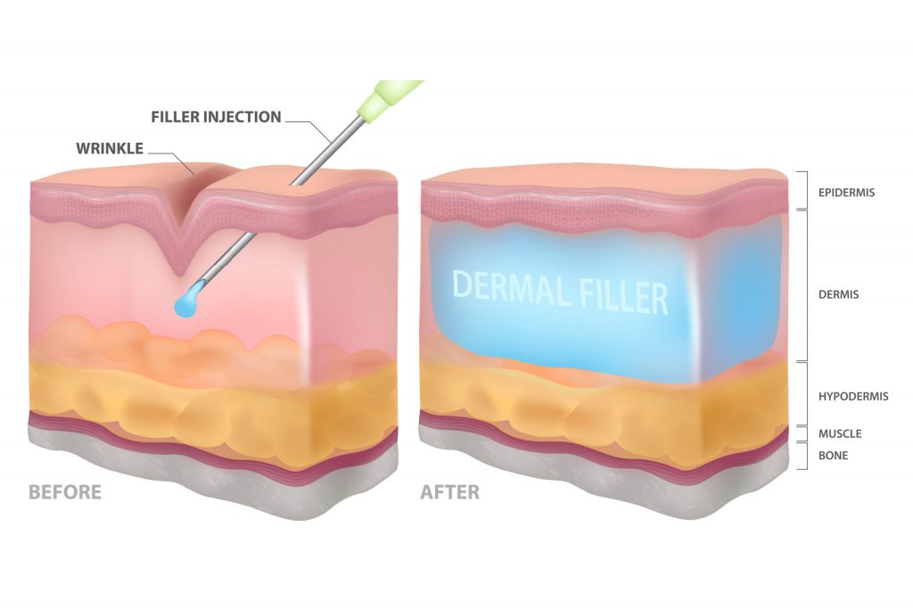 Dermal Filler injections Image