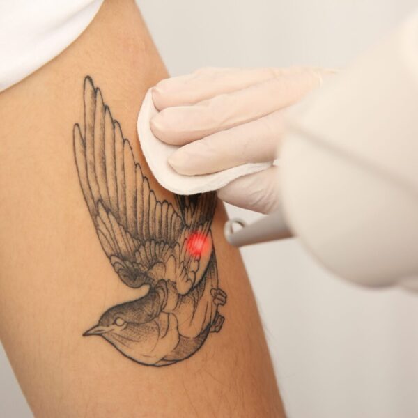 Laser Tattoo Removal