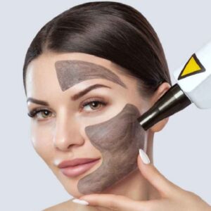 Carbon Peel Laser